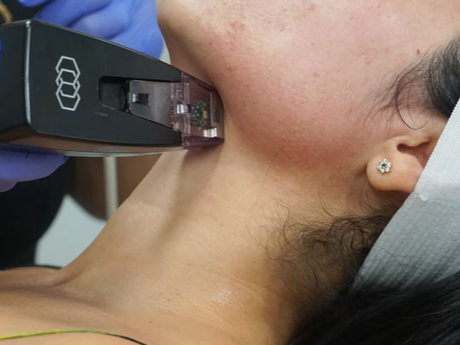 What Makes Morpheus8 Treatment Different From Microneedling?