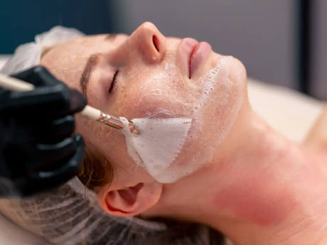 What Does A Chemical Peel Treat?