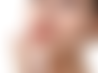 Is Lip Augmentation Suitable for Thin Lips?