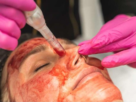Can Vampire Face Lift Improve Facial Firmness?