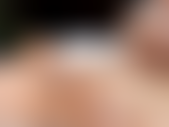 How Long Do Radiesse Fillers Last?