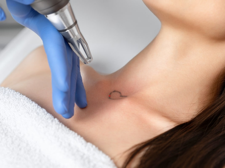 Is Tattoo Removal Safe for Sensitive Skin?