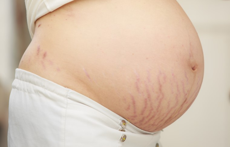 Does Stretch Marks Removal Affect Skin?
