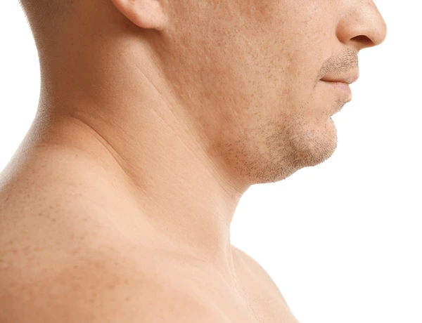 Does Double Chin Removal Address Submental Fullness?