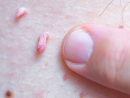 Step-by-Step Guide to Removing Skin Tags from the Inner Thighs