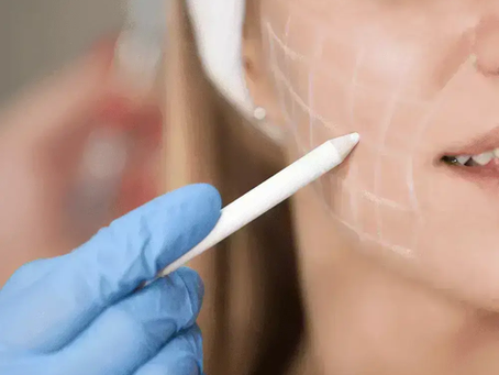 Does Hyacorp Filler Support Volume Enhancement?