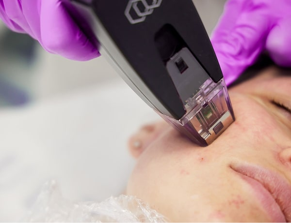 Does Morpheus8 Treatment Improve Skin Texture?