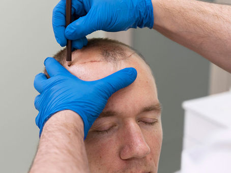When Is the Best Time to Get a Hair Transplant at Ajman & Fujairah?