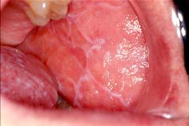 Oral lichen planus 