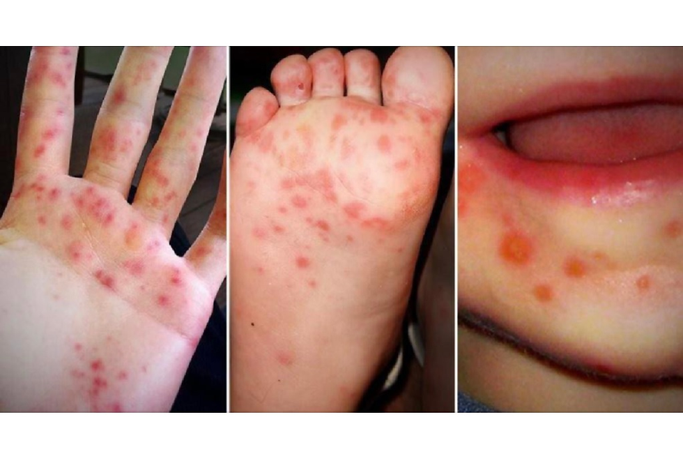 Hand-foot and mouth disease