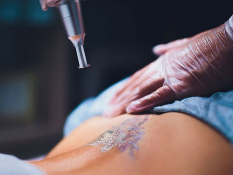 Common Myths About Tattoo Removal
