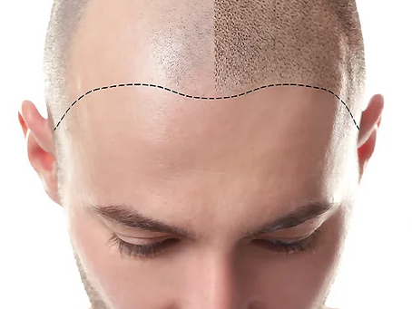Non-Surgical Hair Restoration with Scalp Micropigmentation