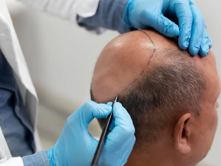 Hair Transplant Cost What You Need to Know