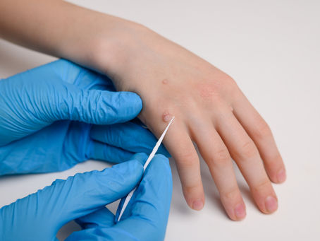 Clear Skin Starts with Professional Warts Removal