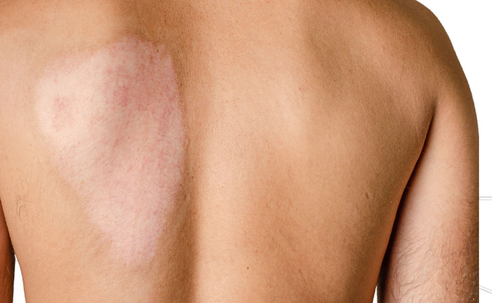 Advanced Scar Repair with Burn Reconstructive Surgery