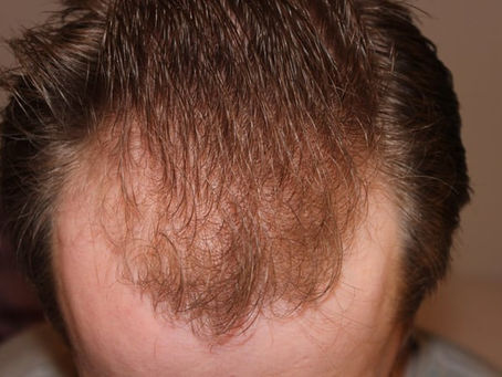 Advanced FUE Hair Transplant Technology 