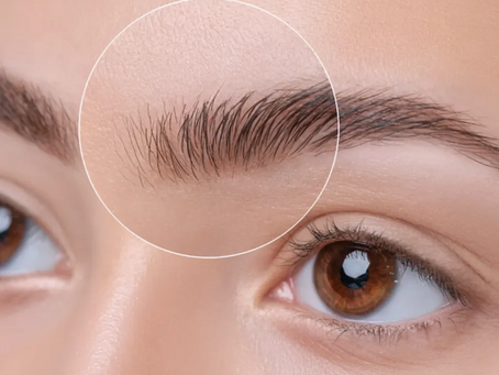 Eyebrow Hair Transplant for Defined Brow Shape