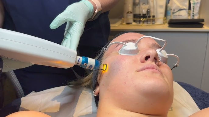 Transform your skin with fractional laser resurfacing