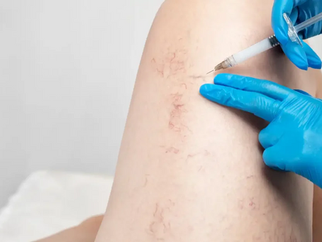 Comprehensive Spider Veins Treatment Services