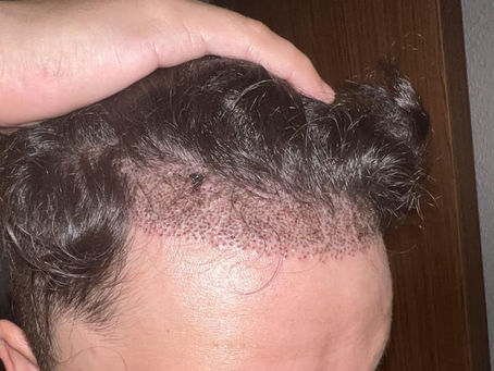 FUE Transplants Minimal Downtime, Maximum Results
