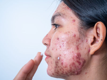 Dermatologist Led Acne Treatment