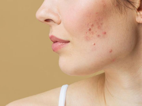 Top Acne Scar Removal Treatments