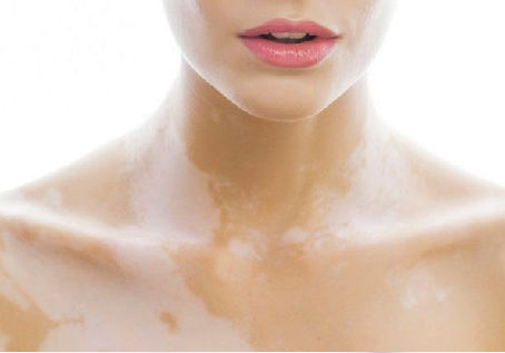 Post-Treatment Skincare Tips for Vitiligo Patients