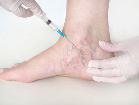 Sclerotherapy The Modern Solution for Spider Veins