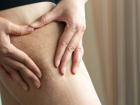 Top-Rated Stretch Mark Removal Specialists