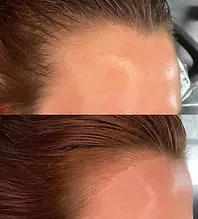 hair-line.webp