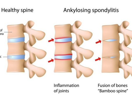 Understanding and Treating Back Pain: A Real Struggle for Many
