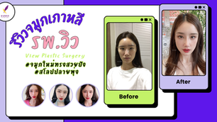 ศัลยกรรมจมูกเกาหลี ละลายฟิลเลอร์เก่าพร้อมกับทำจมูกใหม่ด้วยทรงที่สวยปัง สโลปปลายพุ่ง ที่โรงพยาบาลวิว View Plastic Surgery