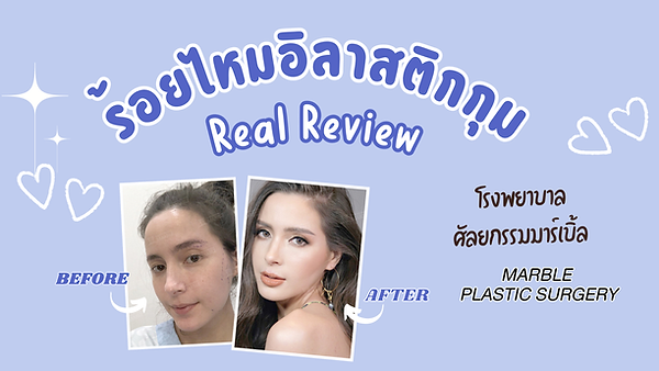 รีวิว ไม่ผิดหวัง ! ร้อยไหมอิลาสติกกุม ยกหนังตาบนแบบกรีดใต้คิ้ว โรงพยาบาลศัลยกรรมมาร์เบิ้ล MARBLE PLASTIC SURGERY