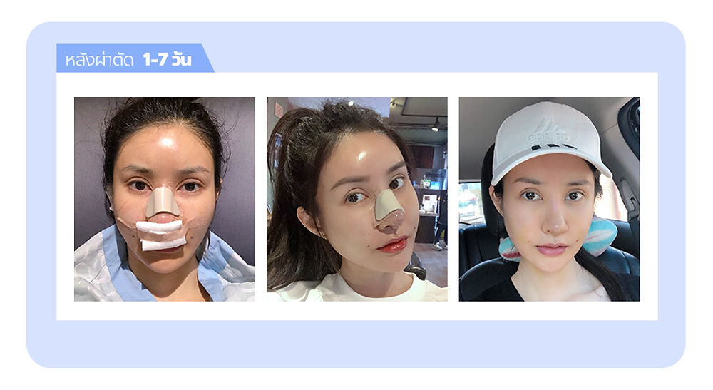 จมูกเรียวพุ่งรับกับใบหน้าตัวเอง แนะนำ โรงพยาบาลศัลยกรรมมาร์เบิ้ล MARBLE PLASTIC SURGERY