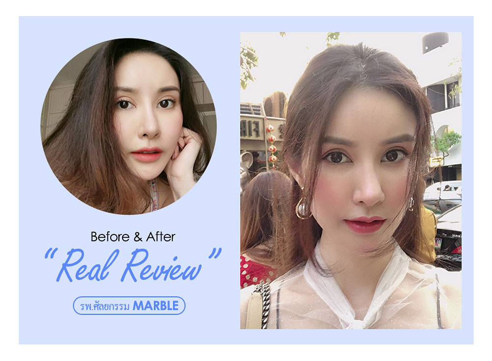 จมูกเรียวพุ่งรับกับใบหน้าตัวเอง แนะนำ โรงพยาบาลศัลยกรรมมาร์เบิ้ล MARBLE PLASTIC SURGERY
