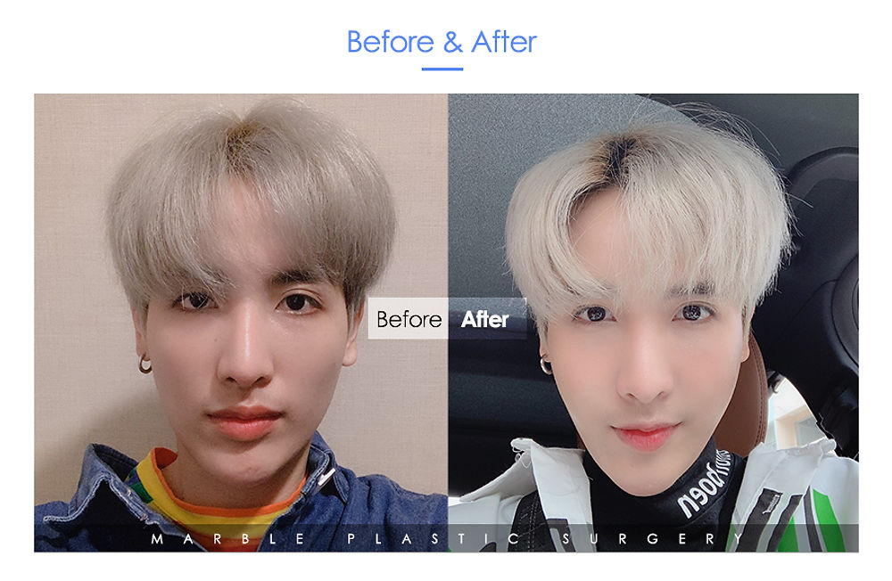 สวย หล่อ ครบจบในที่เดียว โรงพยาบาลศัลยกรรมมาร์เบิ้ล MARBLE PLASTIC SURGERY