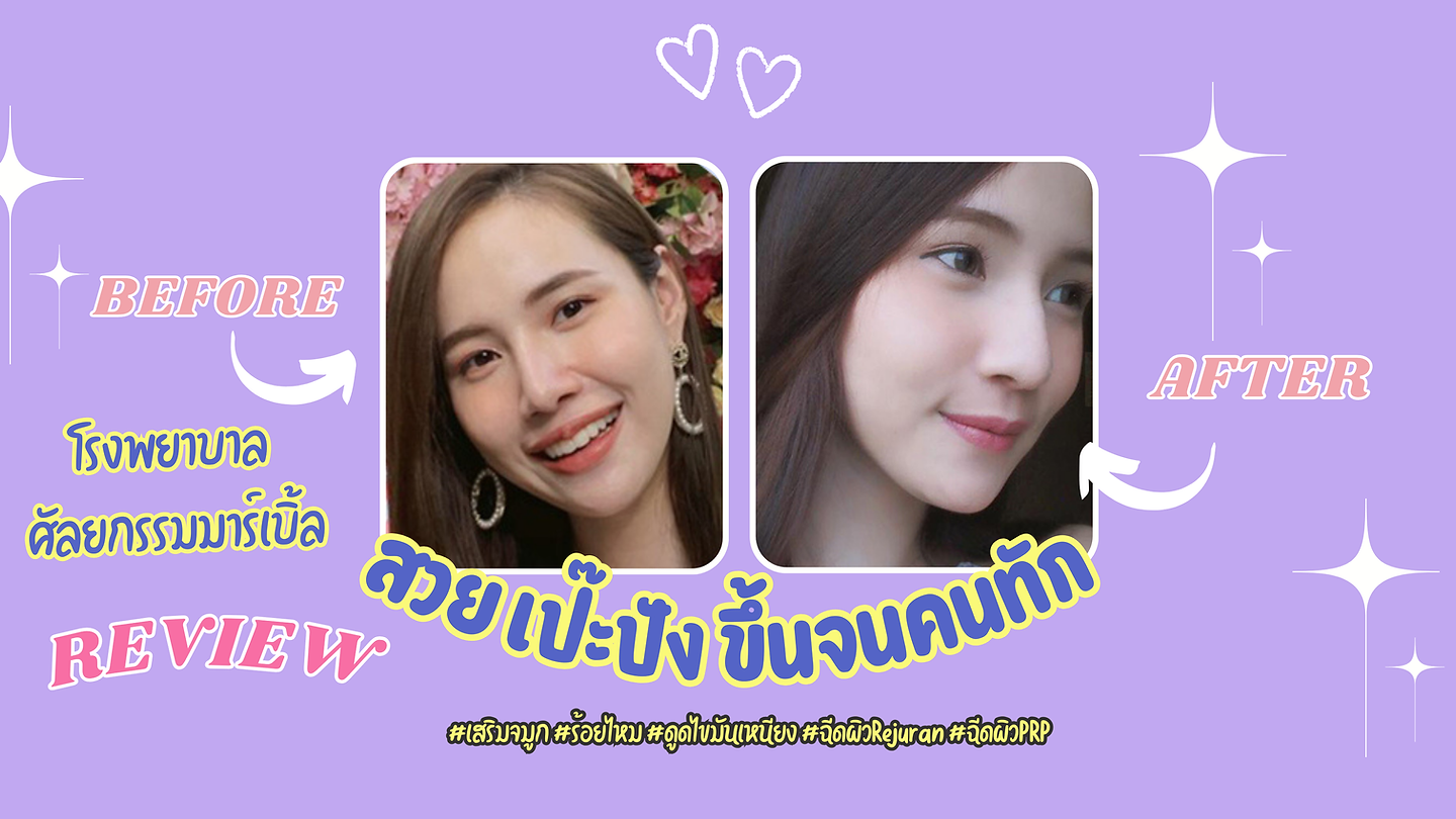 รีวิว สวยขึ้นจนคนทัก! แนะนำโรงพยาบาลศัลยกรรมมาร์เบิ้ล MARBLE PLASTIC SURGERY