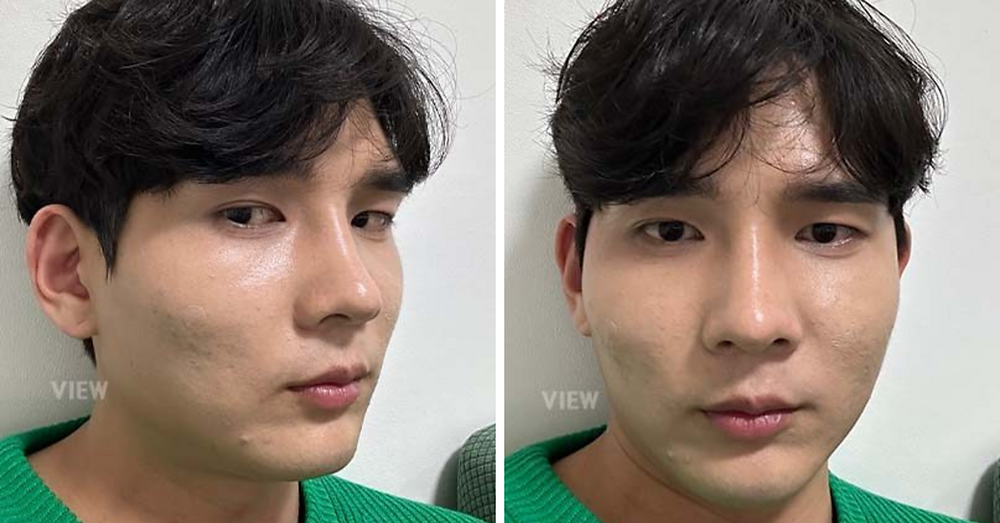REVIEW โครงหน้า 3 จุด ผู้ชาย โรงพยาบาลวิว VIEW Plastic Surgery