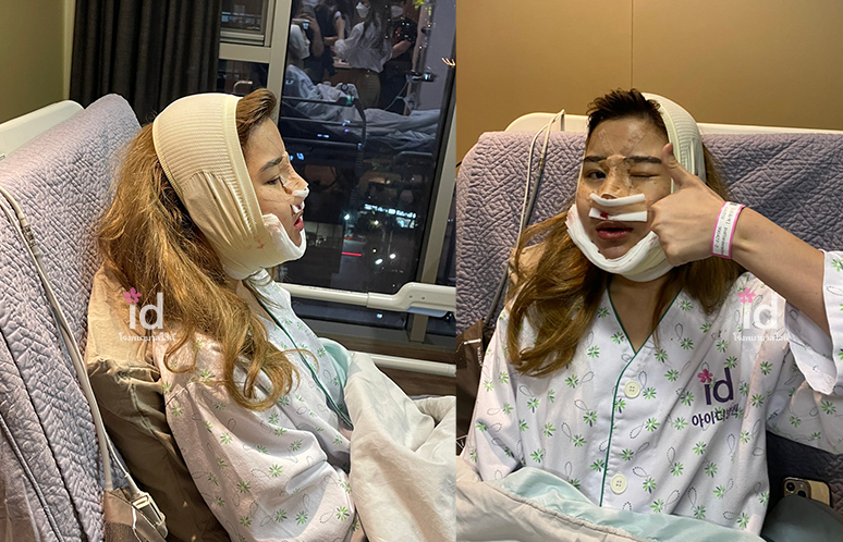 รีวิวศัลยกรรมโครงหน้า จมูก ที่โรงพยาบาลไอดี ID Hospital