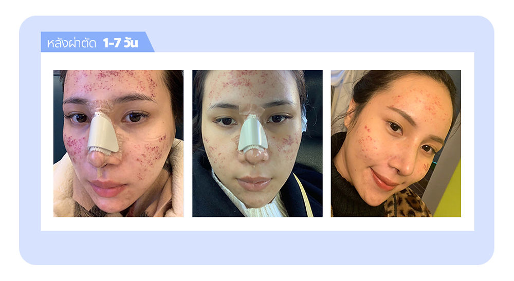 รีวิว สวยขึ้นจนคนทัก! แนะนำโรงพยาบาลศัลยกรรมมาร์เบิ้ล MARBLE PLASTIC SURGERY