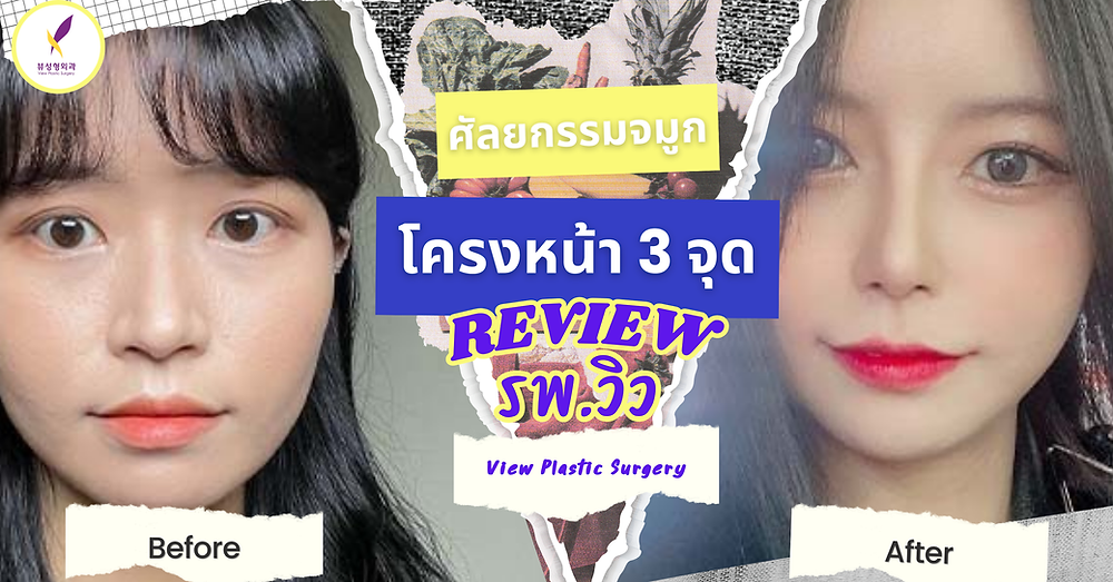โครงหน้า 3 จุด / ศัลยกรรมจมูก โรงพยาบาลวิว VIEW Plastic Surgery