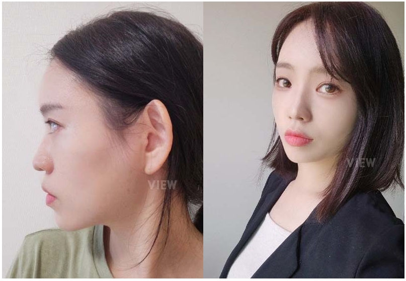 ศัลยกรรมตา / จัดเรียงไขมันใต้ตา / ร้อยไหม / ฉีดไขมันหน้า กลับไปสวยเหมือนตอนช่วงอายุ 20 โรงพยาบาลวิว VIEW Plastic Surgery