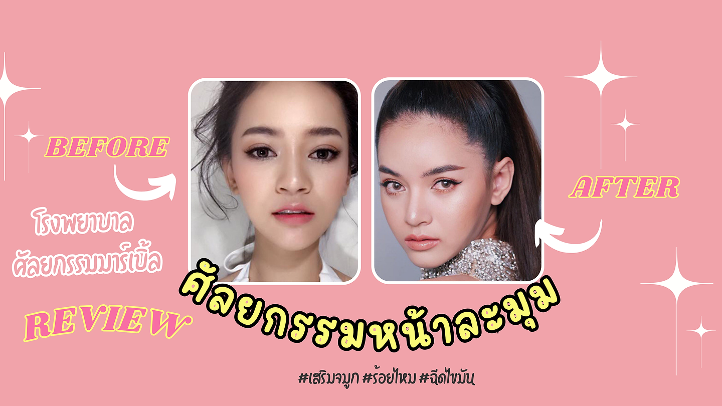 รีวิว หน้าละมุม ลูกสาว โรงพยาบาลศัลยกรรมมาร์เบิ้ล MARBLE PLASTIC SURGERY