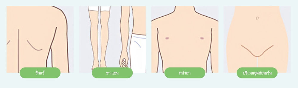 กำจัดขนด้วยเลเซอร์ โรงพยาบาลวอนจิน Wonjin Plastic Surgery