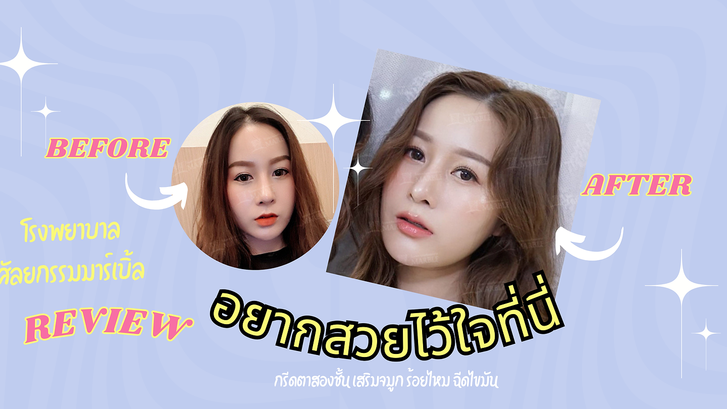 รีวิว กรีดตาสองชั้น เสริมจมูก ร้อยไหม ฉีดไขมัน เลือกโรงพยาบาลศัลยกรรมมาร์เบิ้ล MARBLE PLASTIC SURGERY