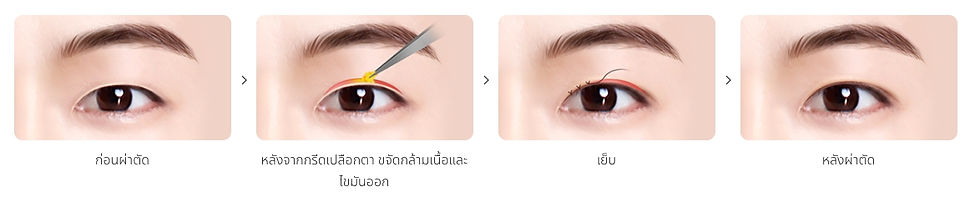 Male Inner Double Eyelid Ptosis Correction (Incision Method)