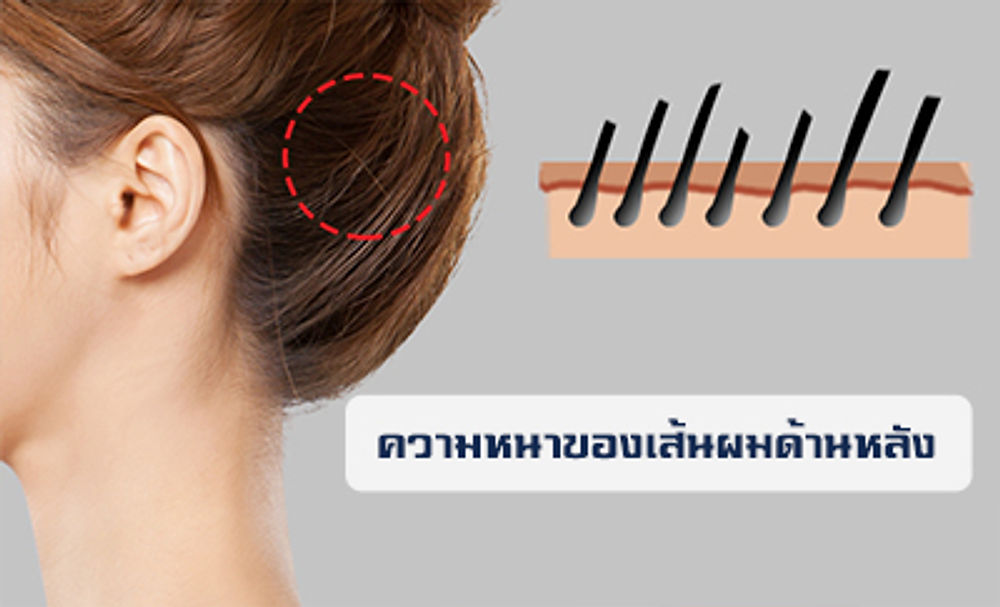 | ข้อดีของการศัลยกรรมลดหน้าผากแฮร์ไลน์