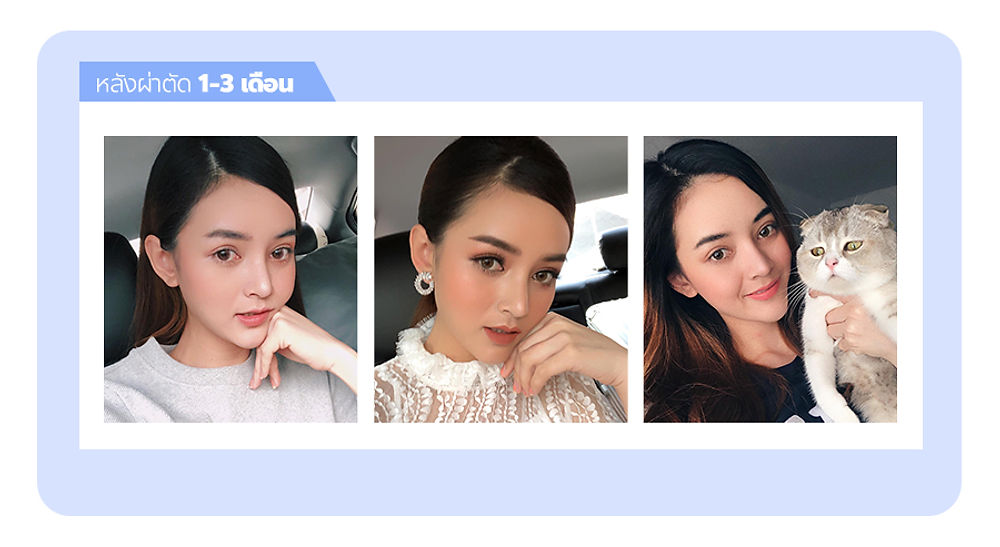 รีวิว หน้าละมุม ลูกสาว โรงพยาบาลศัลยกรรมมาร์เบิ้ล MARBLE PLASTIC SURGERY