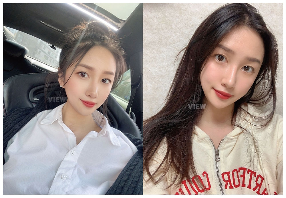 โครงหน้า 3 จุด / ร้อยไหม / ฉีดไขมันหน้า / ดูดไขมันเหนียง ศัลยกรรมปรับโครงหน้าที่ โรงพยาบาลวิว VIEW Plastic Surgery
