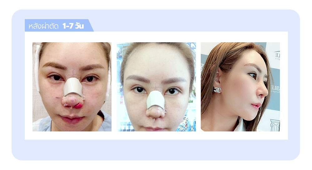 รีวิวหน้าเป๊ะ! ครบจบ ที่โรงพยาบาลศัลยกรรมมาร์เบิ้ล MARBLE PLASTIC SURGERY